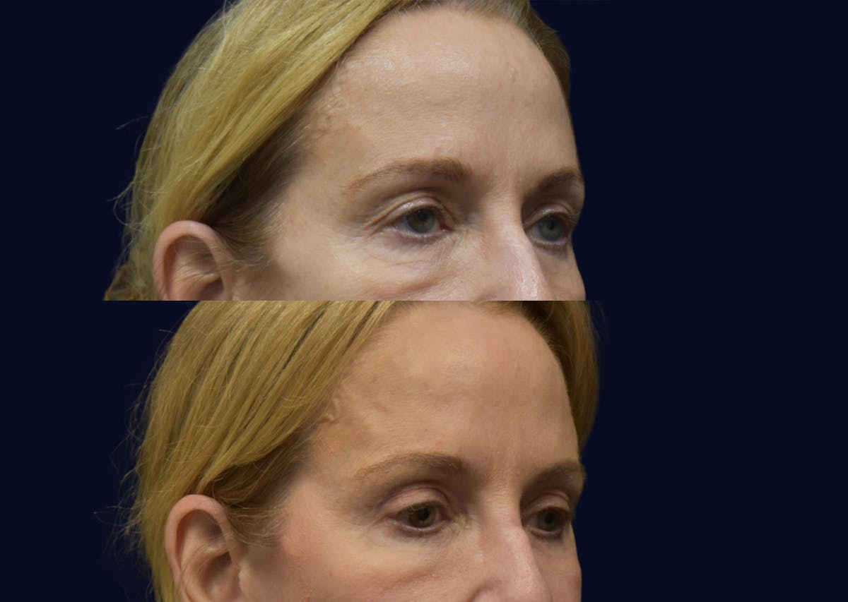 Blepharoplasty (Eyelid Surgery) Before & After Gallery - Patient 324403 - Image 1