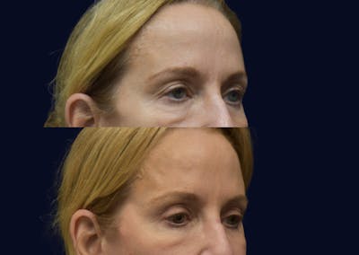 CO2 Laser Before & After Gallery - Patient 104235 - Image 1