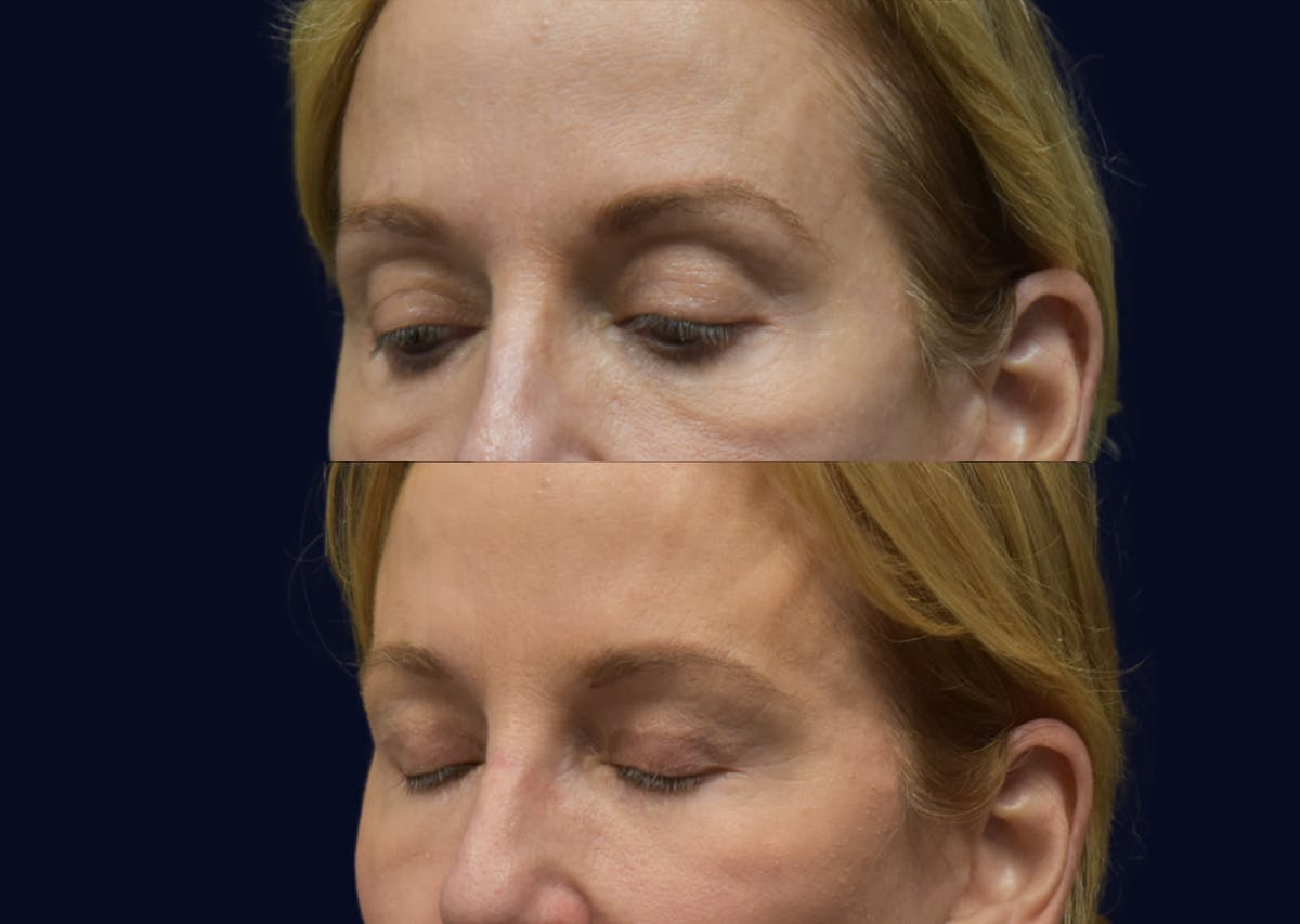 Blepharoplasty (Eyelid Surgery) Before & After Gallery - Patient 324403 - Image 3