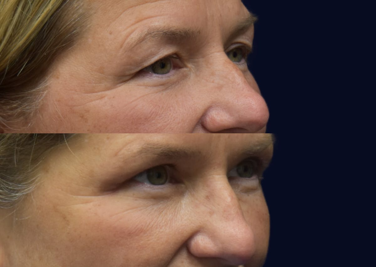 Blepharoplasty (Eyelid Surgery) Before & After Gallery - Patient 983223 - Image 1
