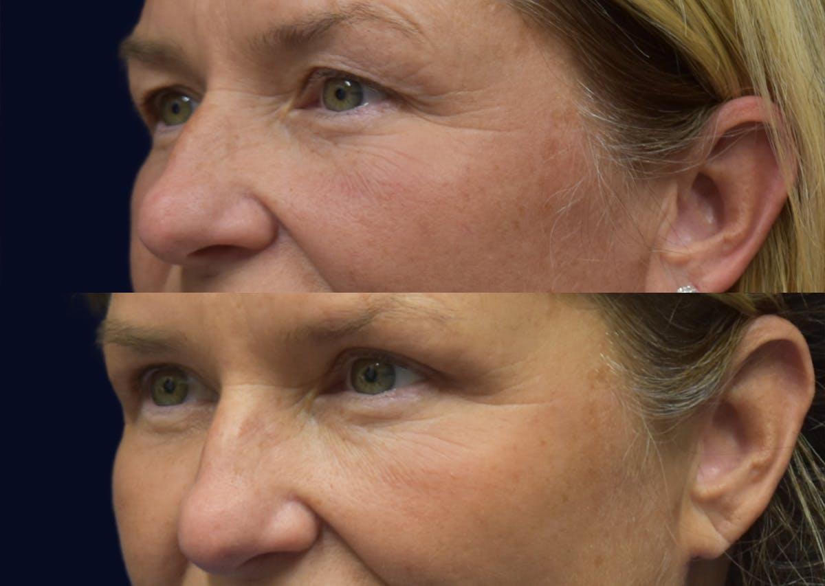Blepharoplasty (Eyelid Surgery) Before & After Gallery - Patient 983223 - Image 2