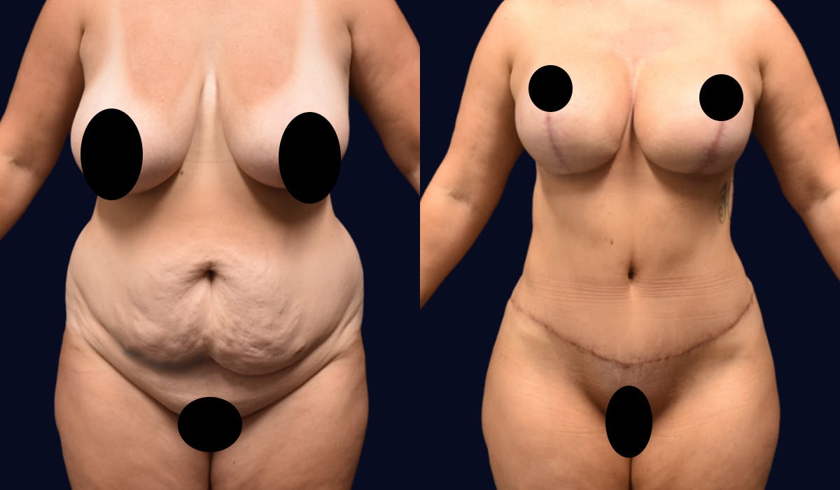 Abdominoplasty (Tummy Tuck) Before & After Gallery - Patient 190875 - Image 1
