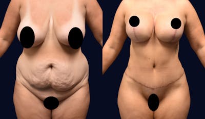Abdominoplasty (Tummy Tuck) Before & After Gallery - Patient 190875 - Image 1