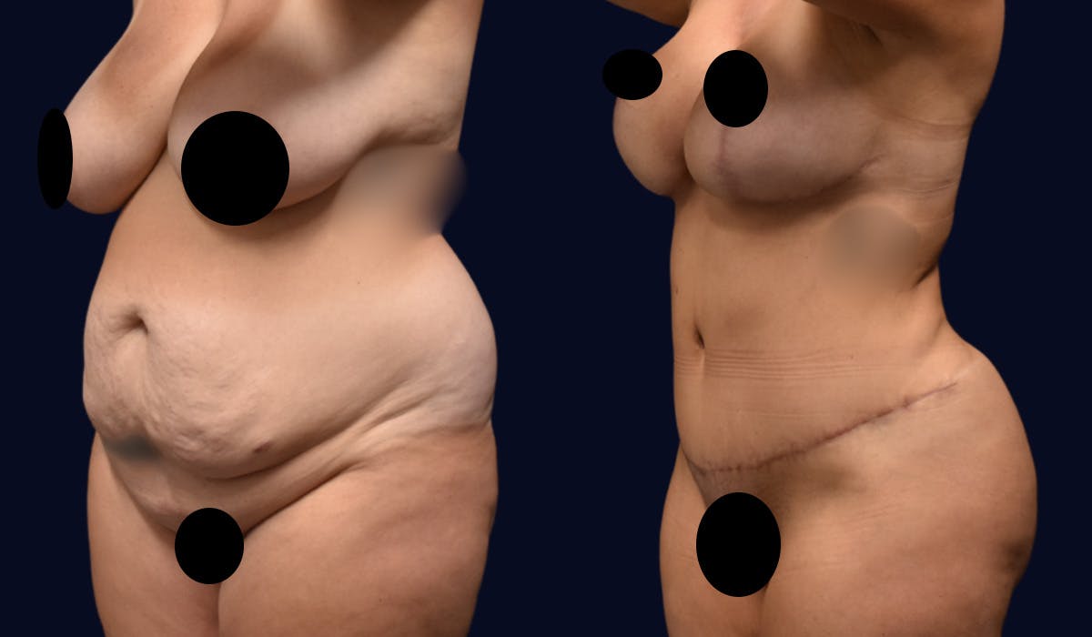 Abdominoplasty (Tummy Tuck) Before & After Gallery - Patient 190875 - Image 2