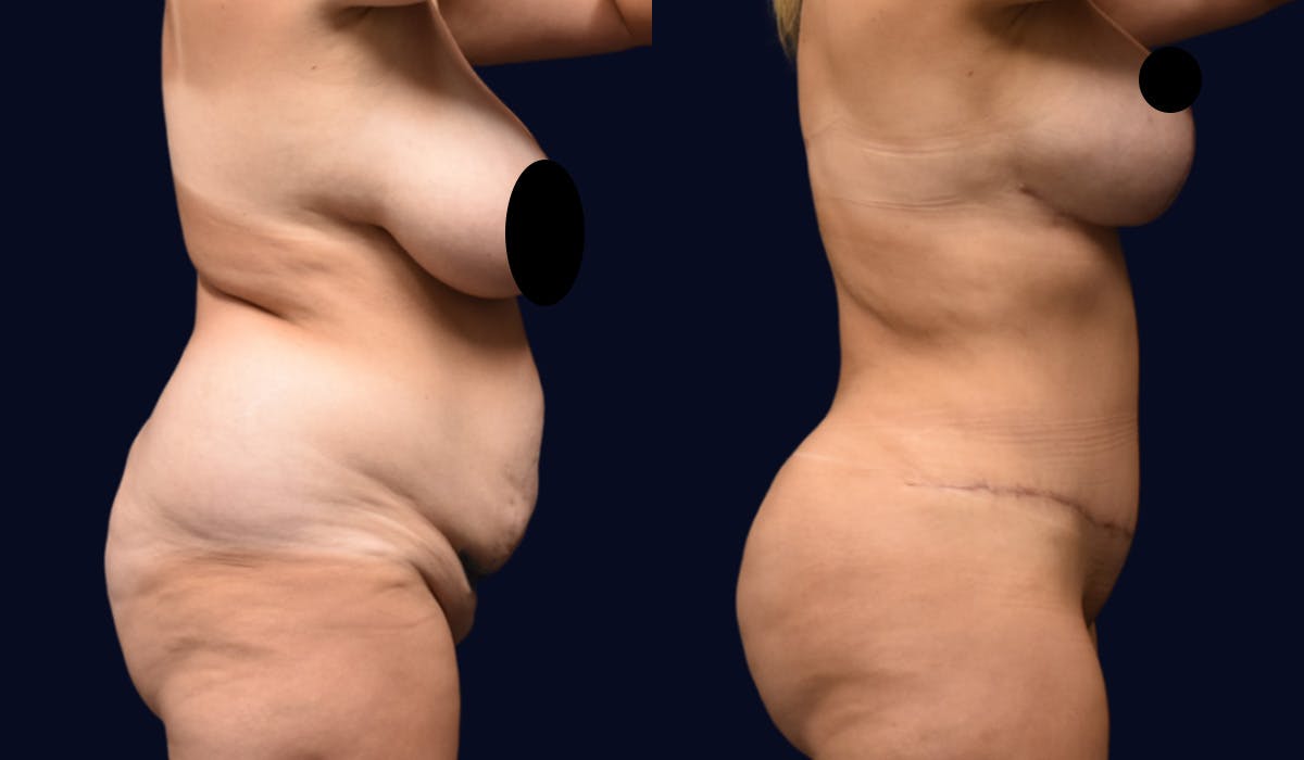 Abdominoplasty (Tummy Tuck) Before & After Gallery - Patient 190875 - Image 3