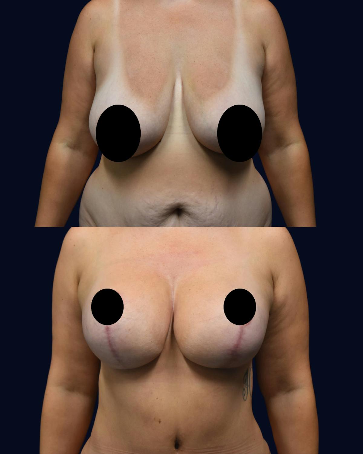 Breast Lift with Implants Before & After Gallery - Patient 235031 - Image 1