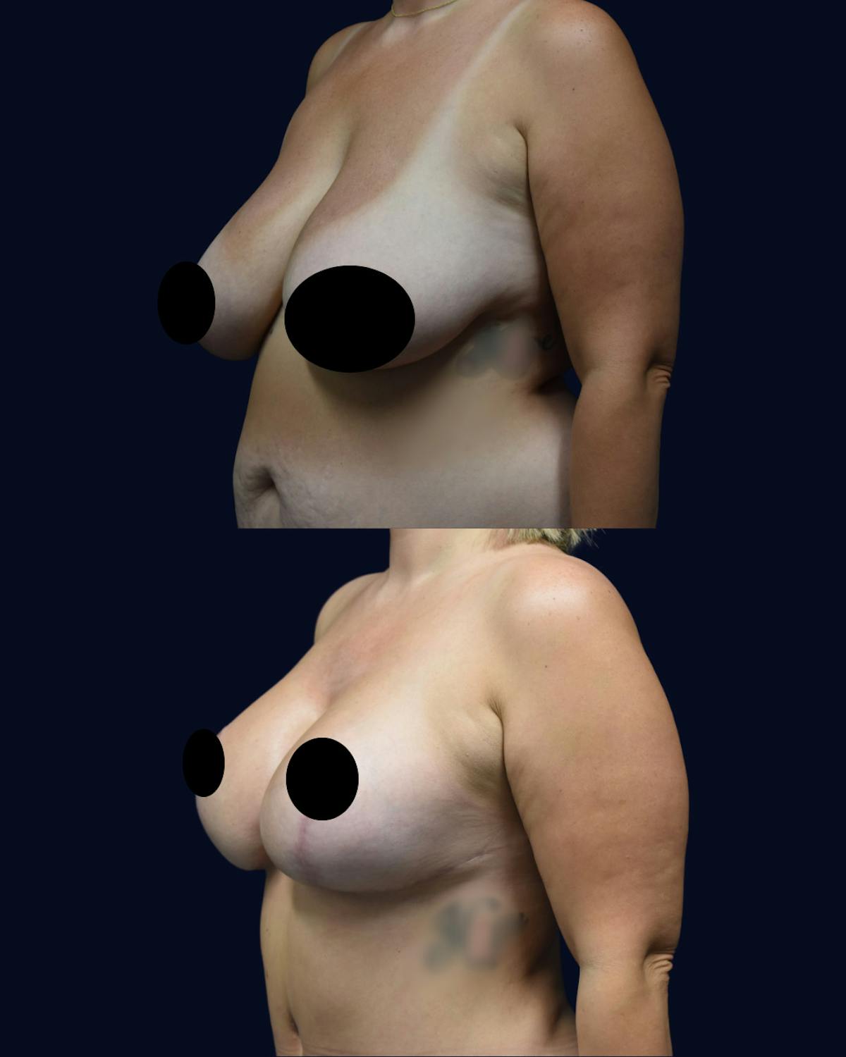 Breast Lift with Implants Before & After Gallery - Patient 235031 - Image 2