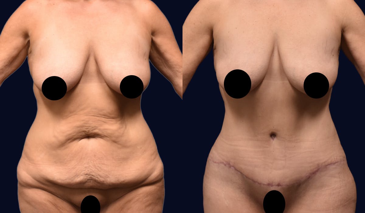 Abdominoplasty with Liposuction Before & After Gallery - Patient 347769 - Image 1