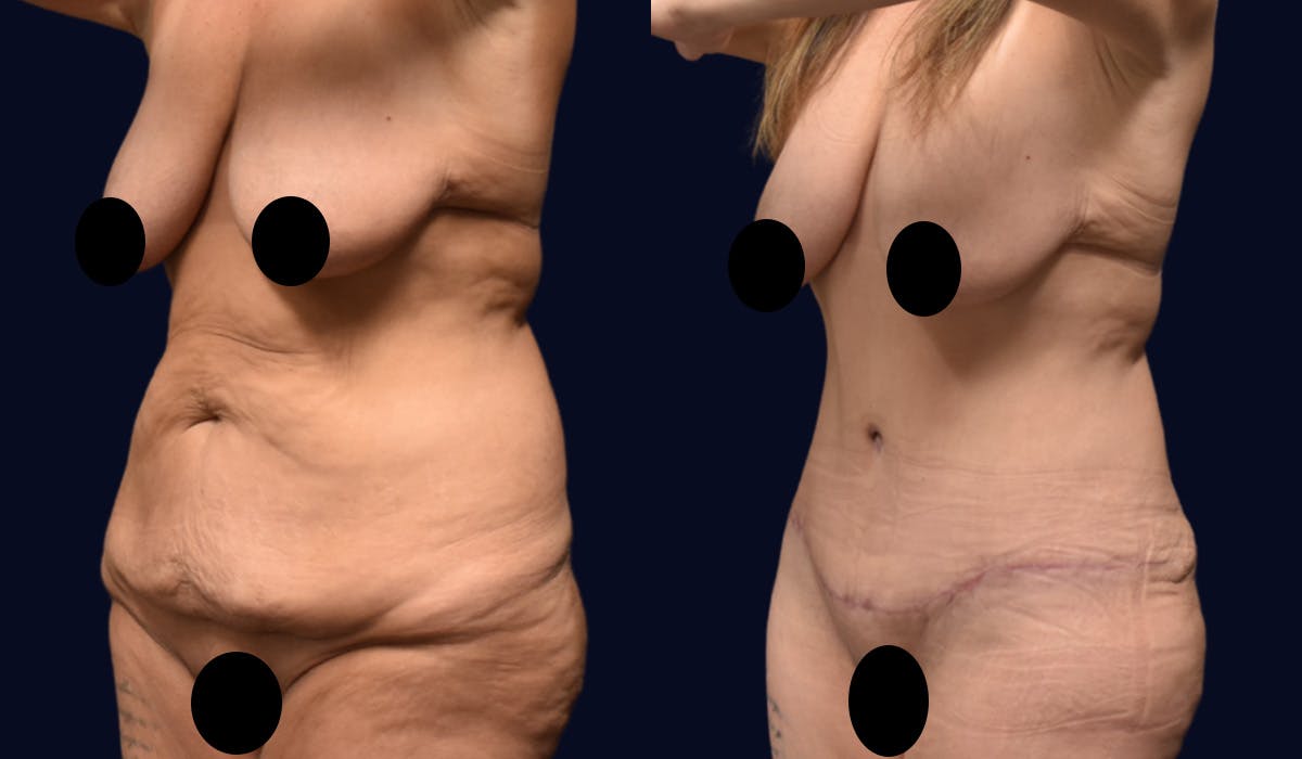 Abdominoplasty with Liposuction Before & After Gallery - Patient 347769 - Image 2