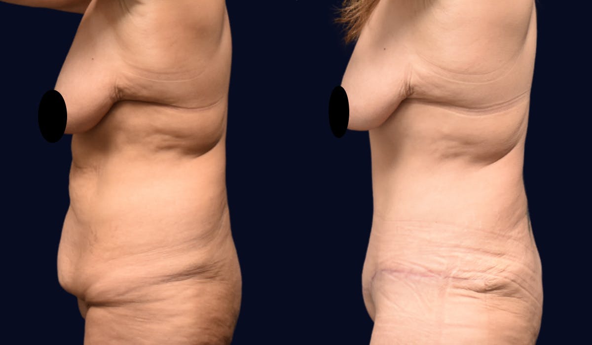 Abdominoplasty with Liposuction Before & After Gallery - Patient 347769 - Image 3
