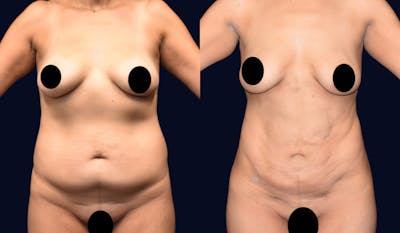 Abdominoplasty with Liposuction Before & After Gallery - Patient 308797 - Image 1