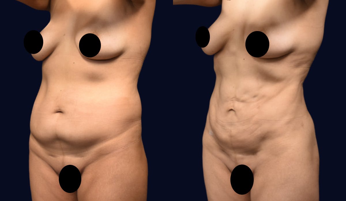 Abdominoplasty with Liposuction Before & After Gallery - Patient 308797 - Image 2