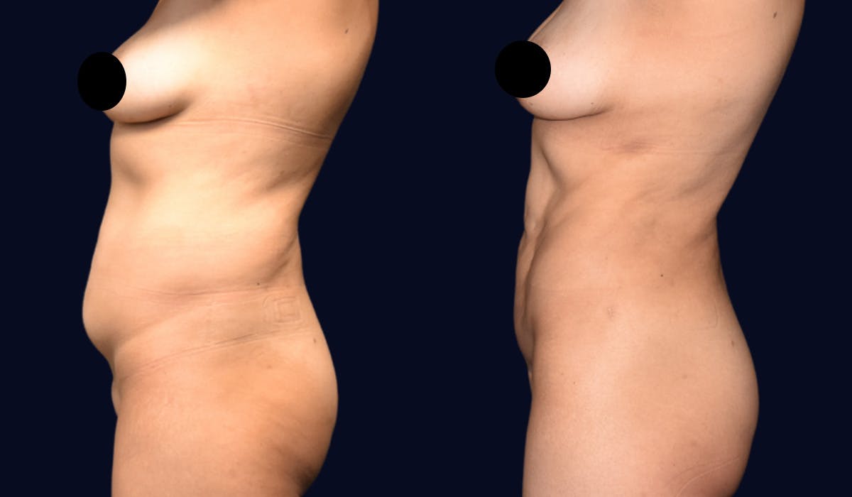 Abdominoplasty with Liposuction Before & After Gallery - Patient 308797 - Image 3