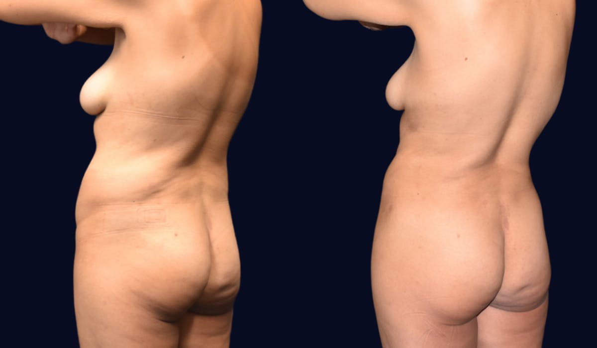 Abdominoplasty with Liposuction Before & After Gallery - Patient 308797 - Image 4