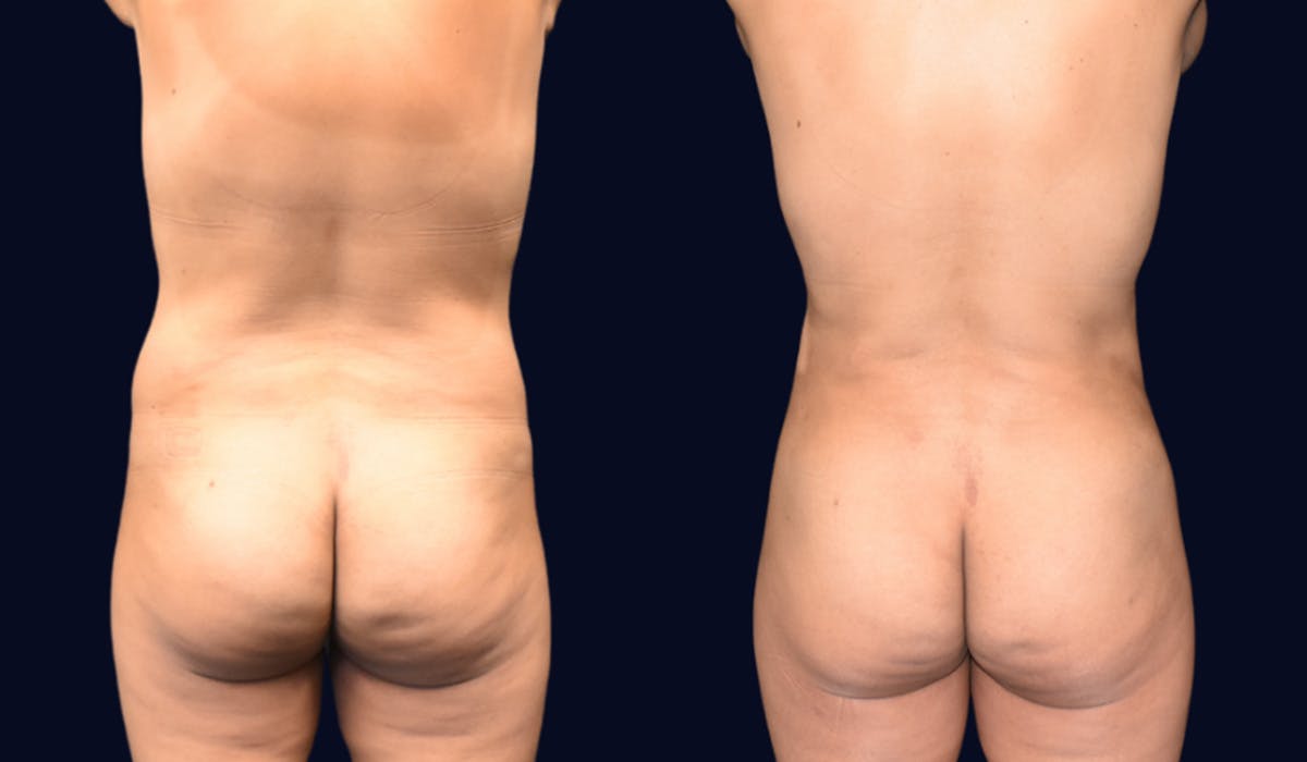 Abdominoplasty with Liposuction Before & After Gallery - Patient 308797 - Image 5