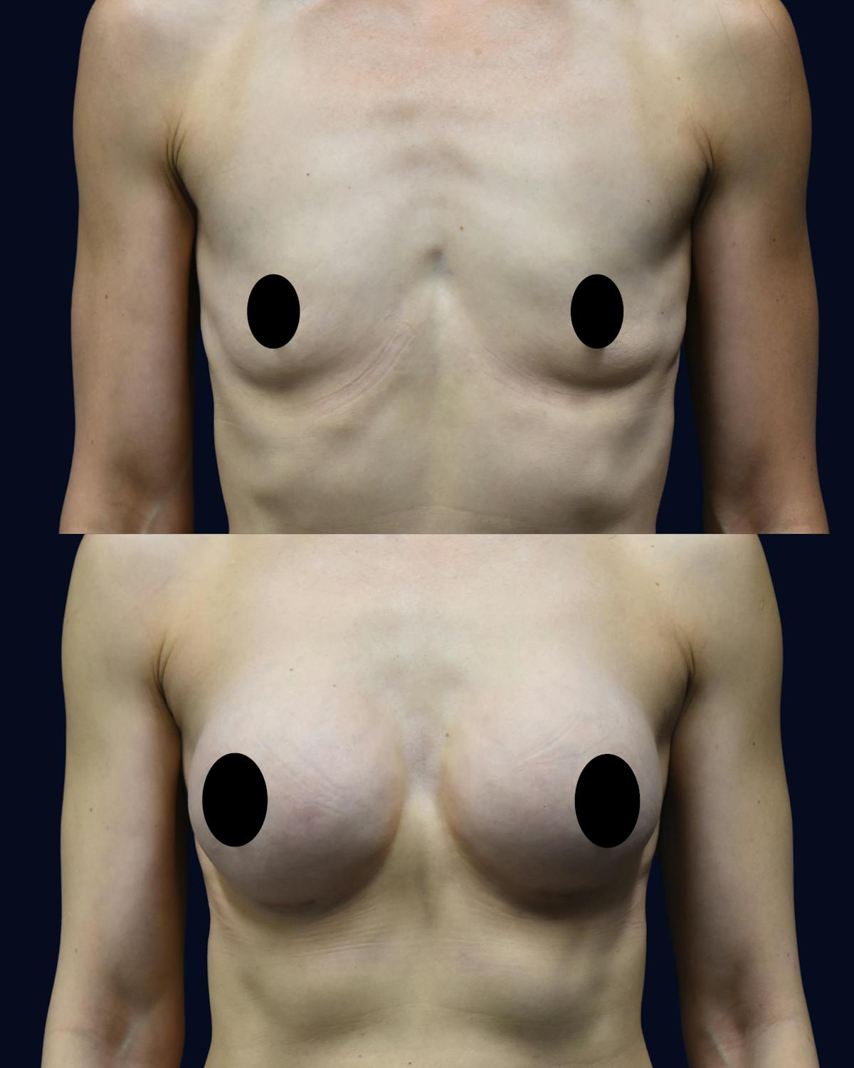 Breast Augmentation Before & After Gallery - Patient 351023 - Image 1