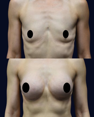 Breast Augmentation Before & After Gallery - Patient 351023 - Image 1