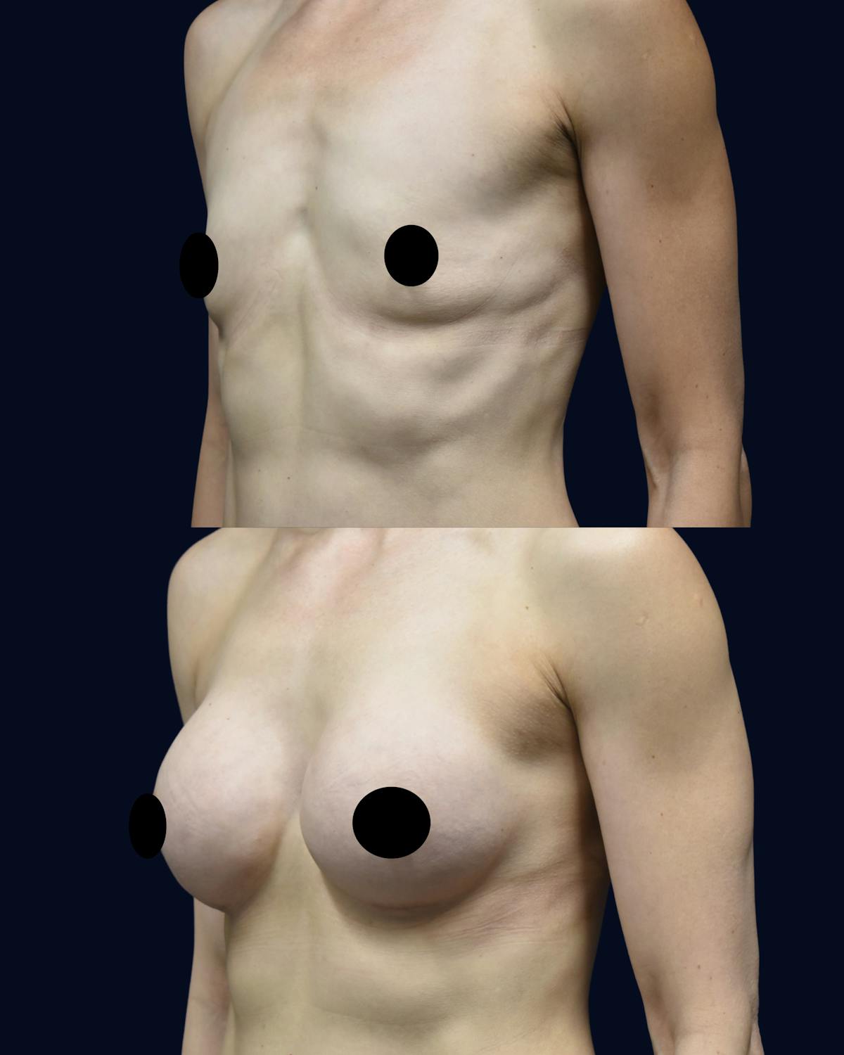 Breast Augmentation Before & After Gallery - Patient 351023 - Image 3
