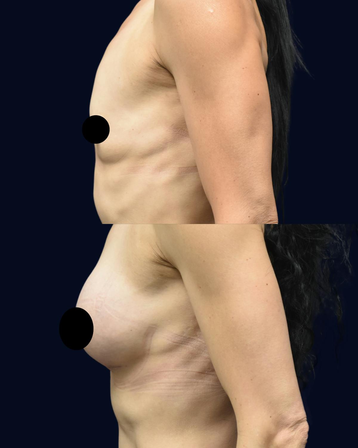 Breast Augmentation Before & After Gallery - Patient 351023 - Image 4