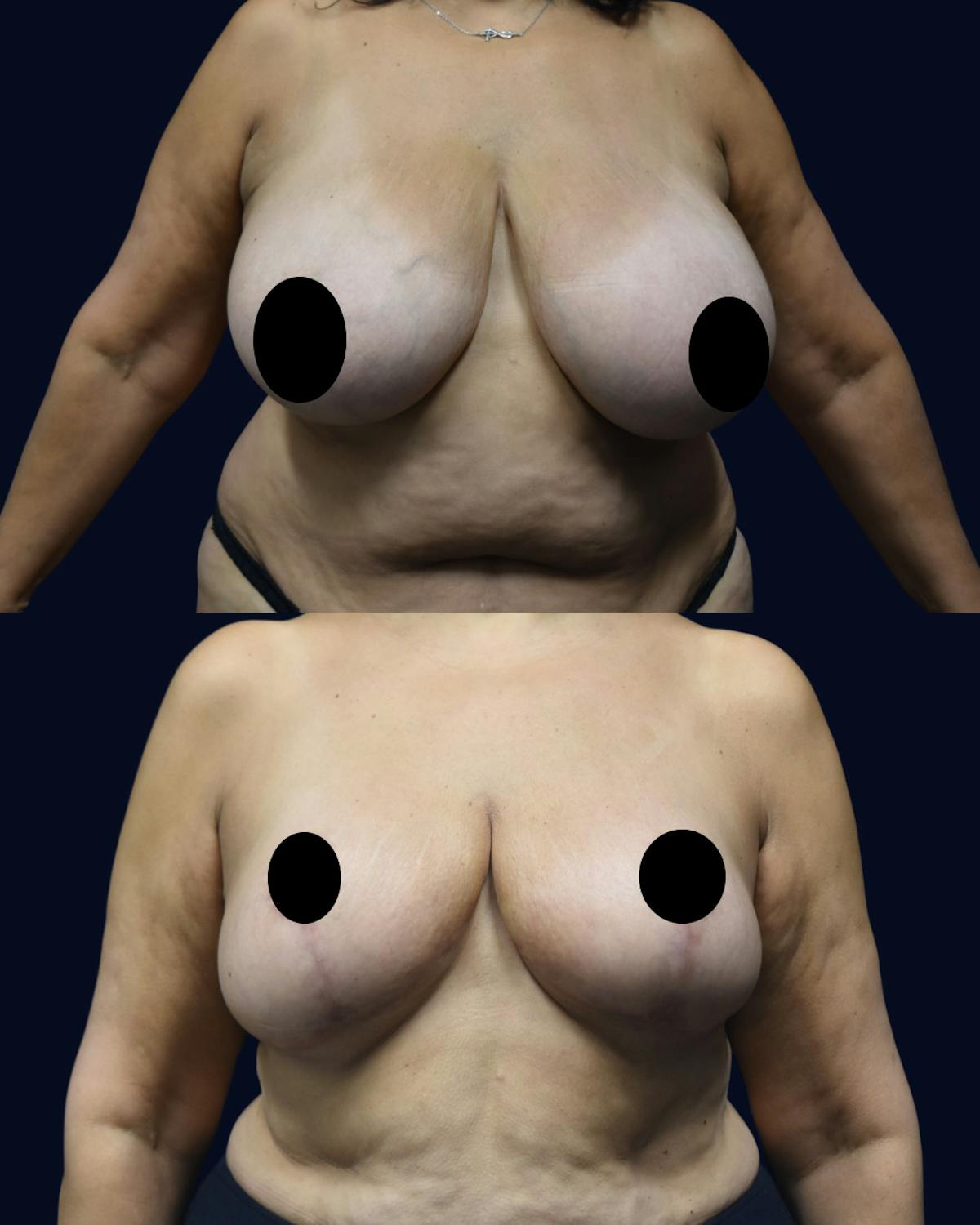 Breast Reduction Before & After Gallery - Patient 934968 - Image 1