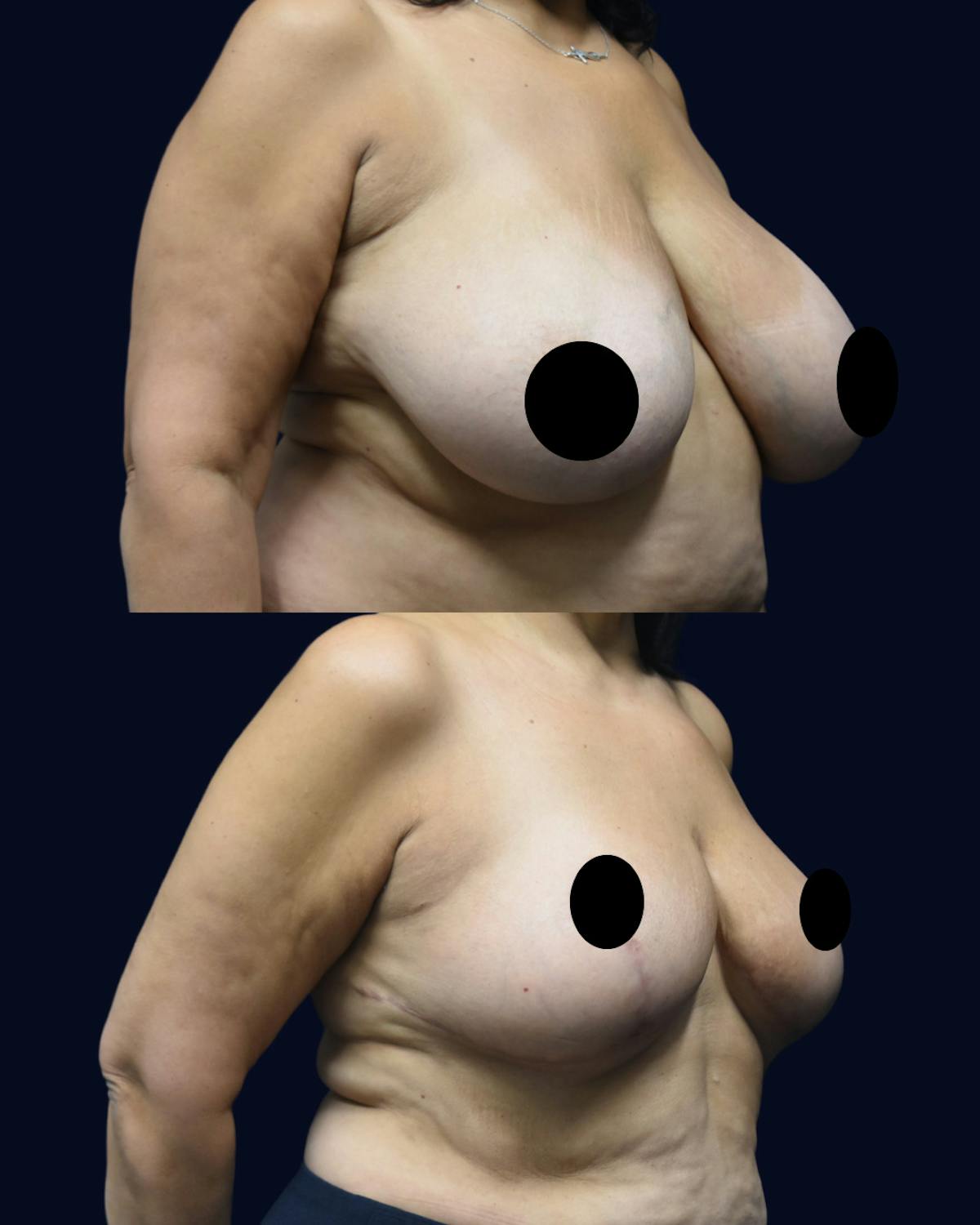 Breast Reduction Before & After Gallery - Patient 934968 - Image 2