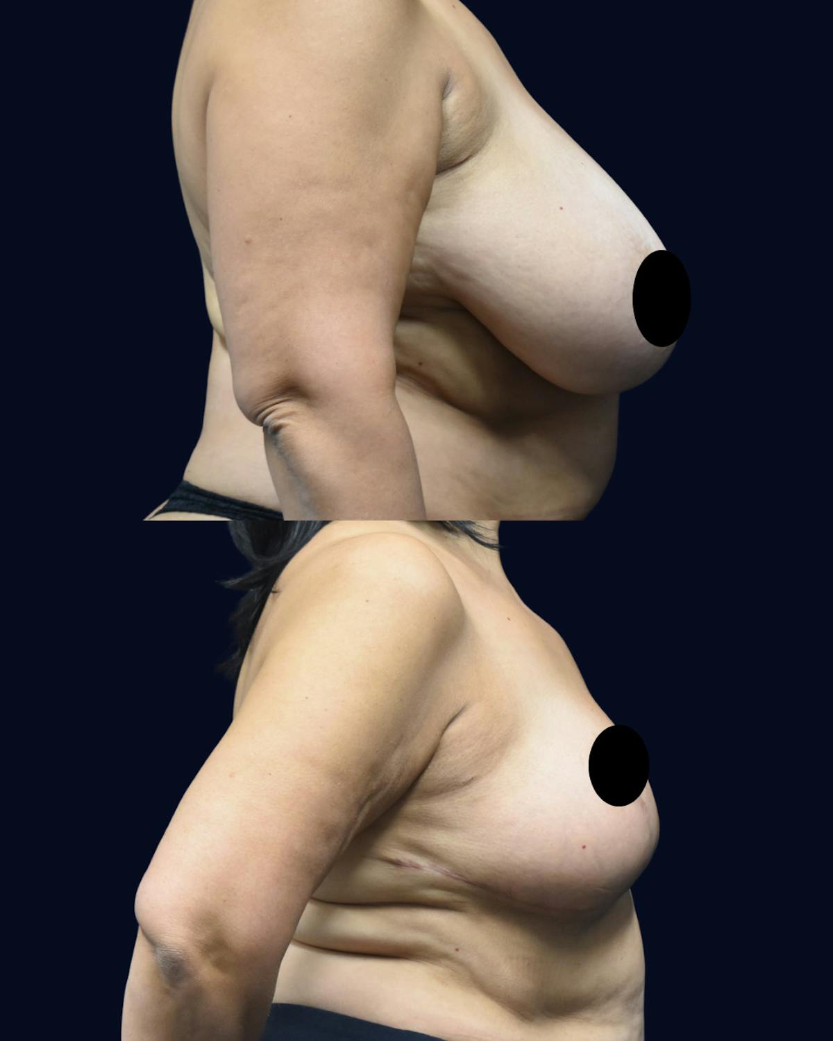 Breast Reduction Before & After Gallery - Patient 934968 - Image 3