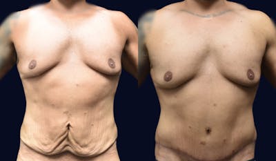 Abdominoplasty with Liposuction Before & After Gallery - Patient 320231 - Image 1