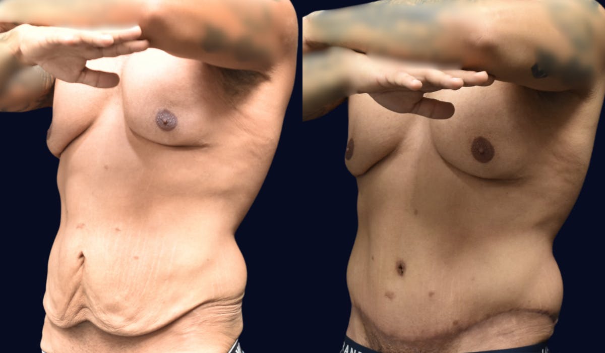 Abdominoplasty with Liposuction Before & After Gallery - Patient 320231 - Image 2