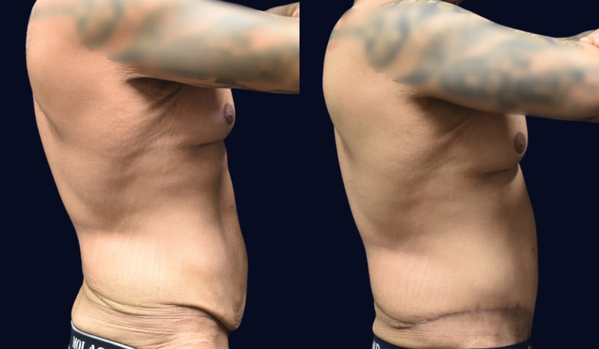 Abdominoplasty with Liposuction Before & After Gallery - Patient 320231 - Image 3