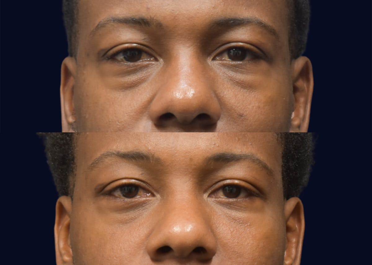 Blepharoplasty (Eyelid Surgery) Before & After Gallery - Patient 268735 - Image 1