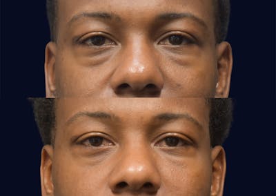 Blepharoplasty (Eyelid Surgery) Before & After Gallery - Patient 268735 - Image 1