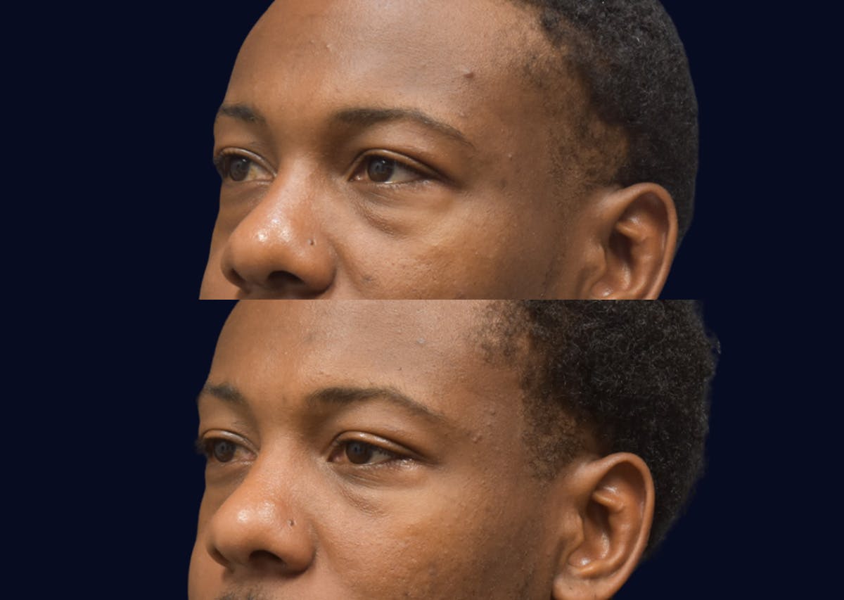 Blepharoplasty (Eyelid Surgery) Before & After Gallery - Patient 268735 - Image 2