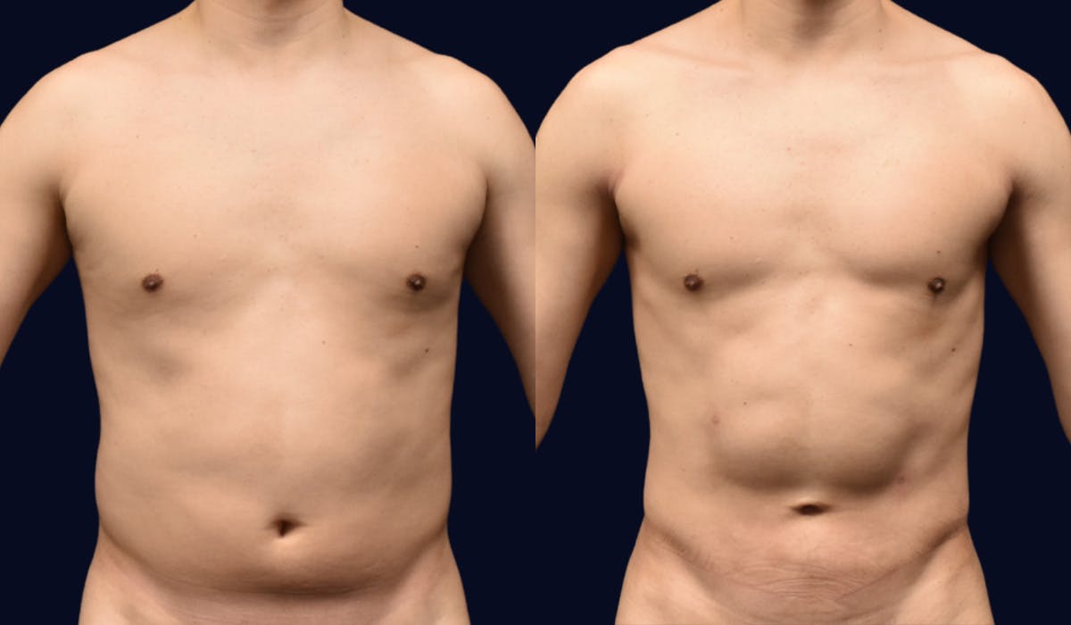 Liposuction Before & After Gallery - Patient 132865 - Image 1