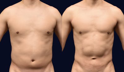 Liposuction Before & After Gallery - Patient 132865 - Image 1