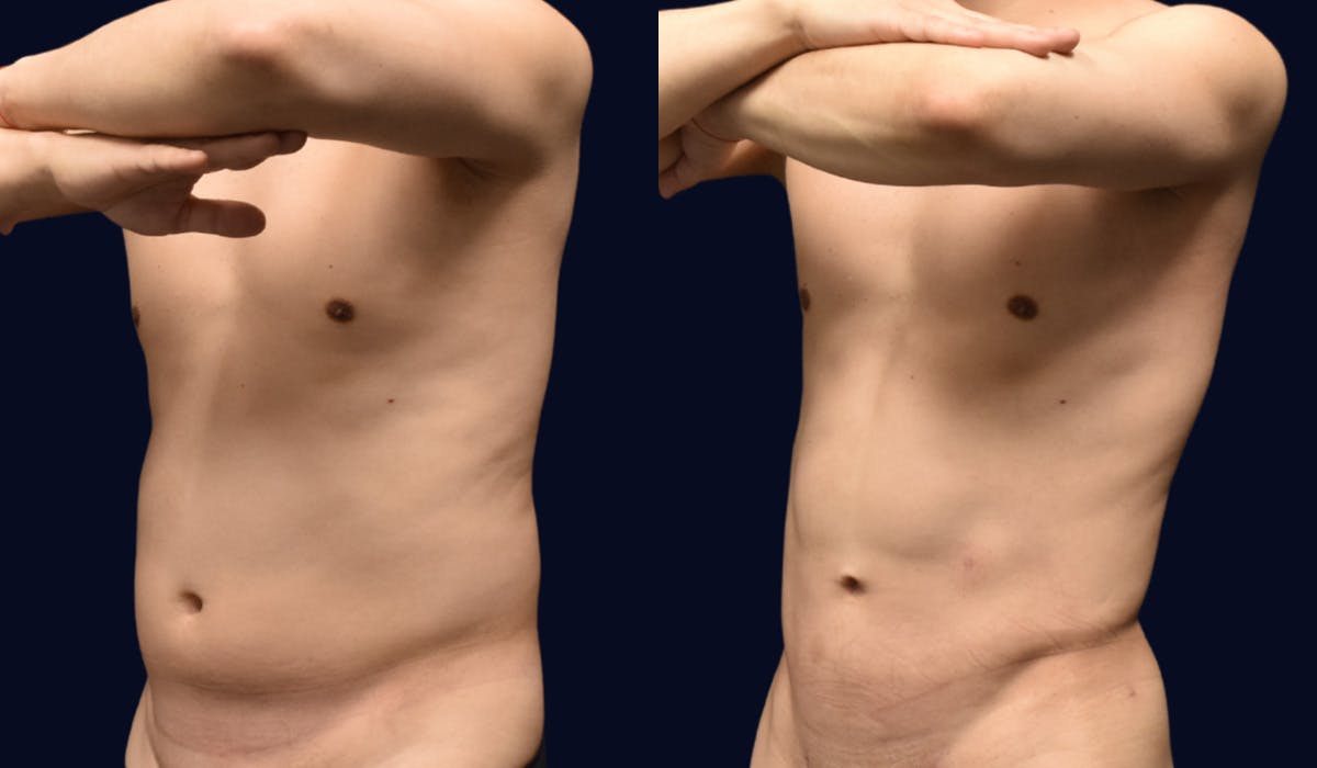 Liposuction Before & After Gallery - Patient 132865 - Image 2