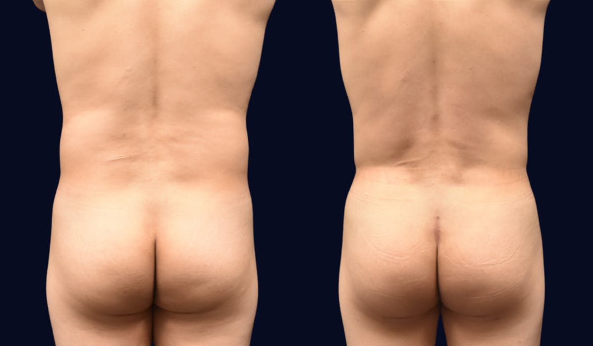 Liposuction Before & After Gallery - Patient 132865 - Image 3