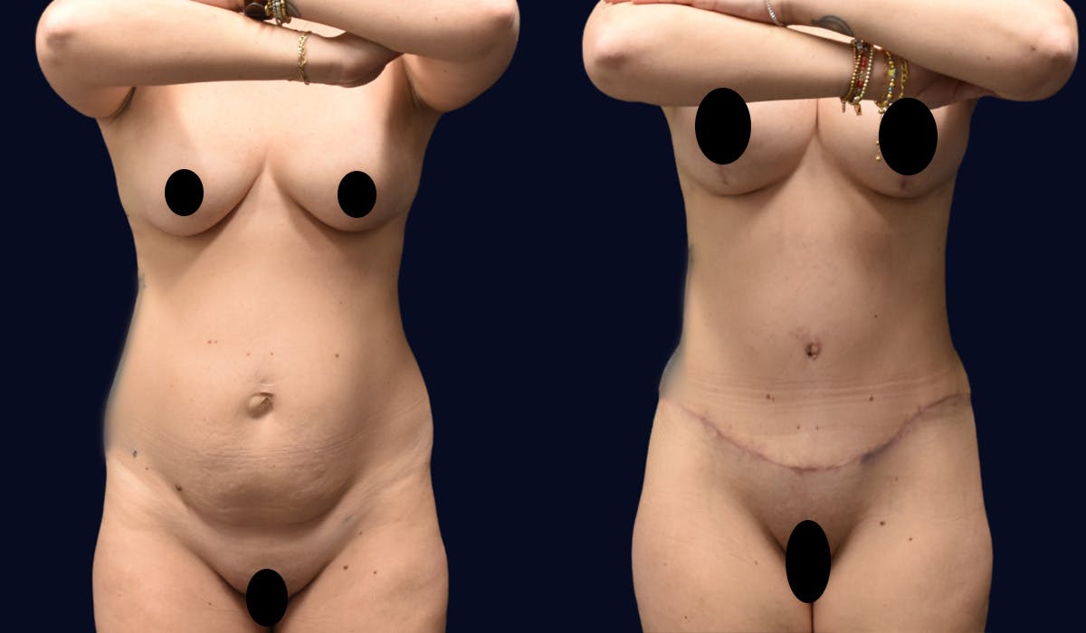 Abdominoplasty (Tummy Tuck) Before & After Gallery - Patient 345943 - Image 2
