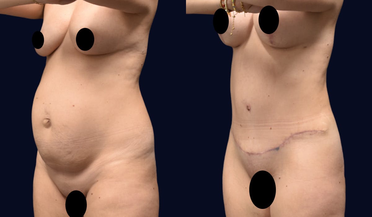 Abdominoplasty (Tummy Tuck) Before & After Gallery - Patient 345943 - Image 3