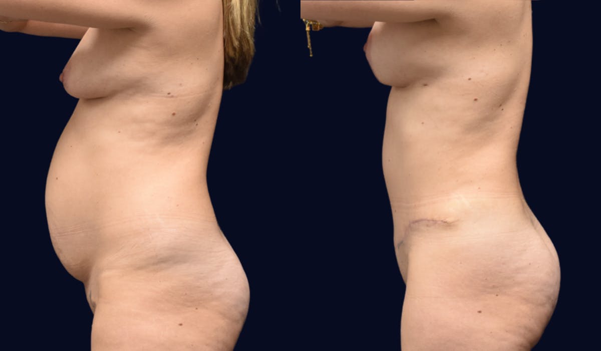 Abdominoplasty (Tummy Tuck) Before & After Gallery - Patient 345943 - Image 4