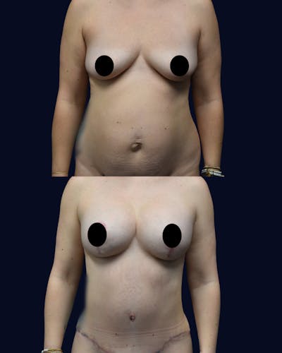 Breast Lift with Implants Before & After Gallery - Patient 167990 - Image 1
