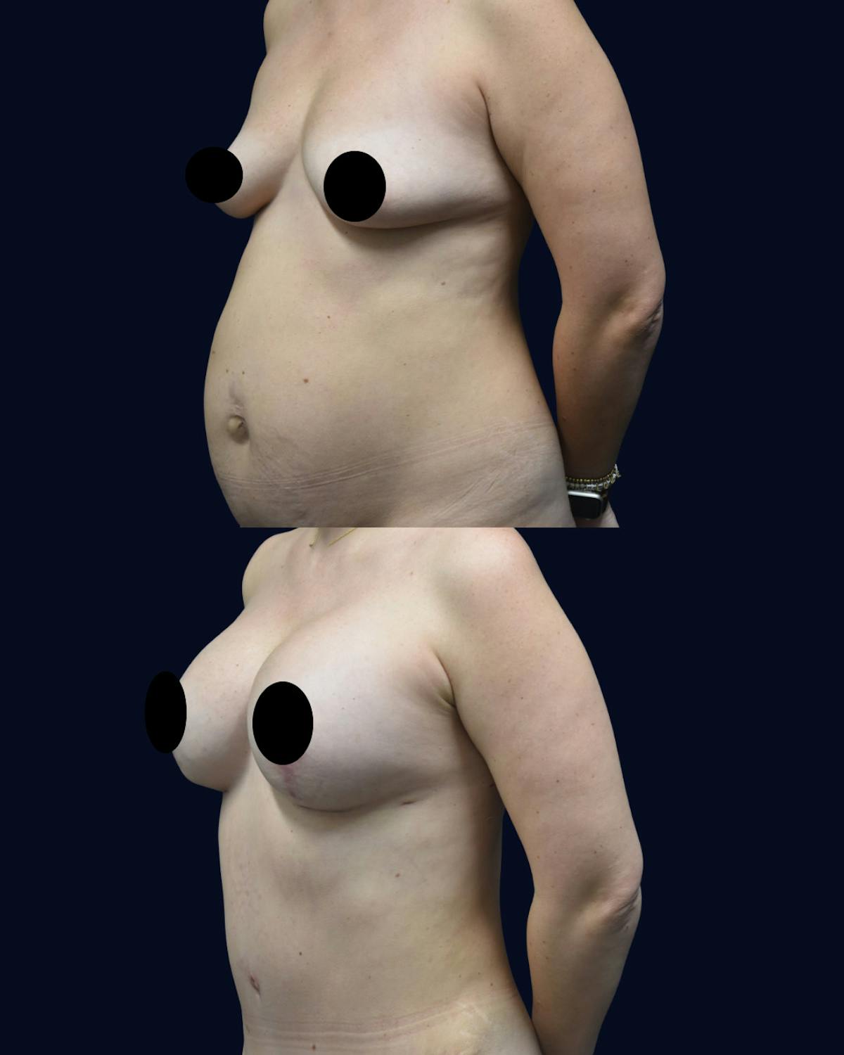 Breast Lift with Implants Before & After Gallery - Patient 167990 - Image 2
