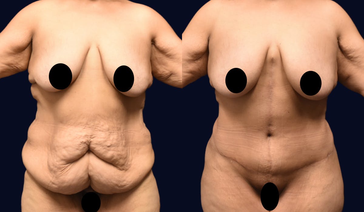 Fleur de Lis Before & After Gallery - Patient 610079 - Image 1