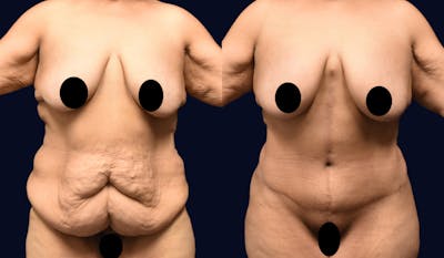 Abdominoplasty with Liposuction Before & After Gallery - Patient 116912 - Image 1