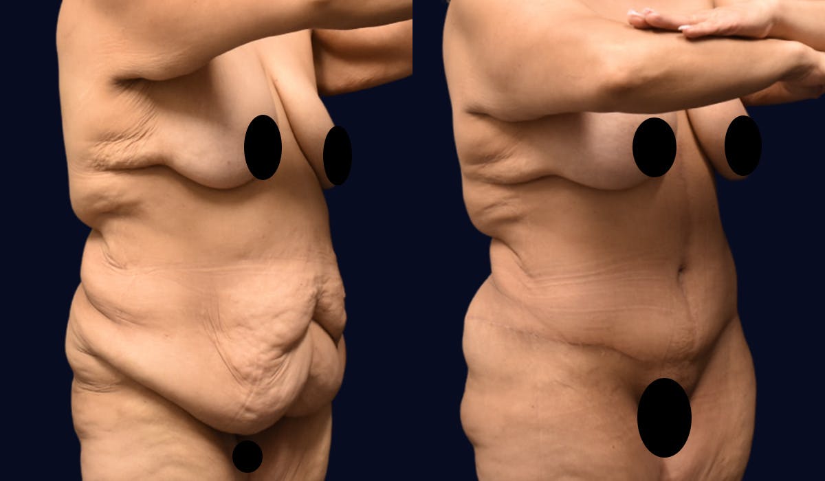 Fleur de Lis Before & After Gallery - Patient 610079 - Image 2