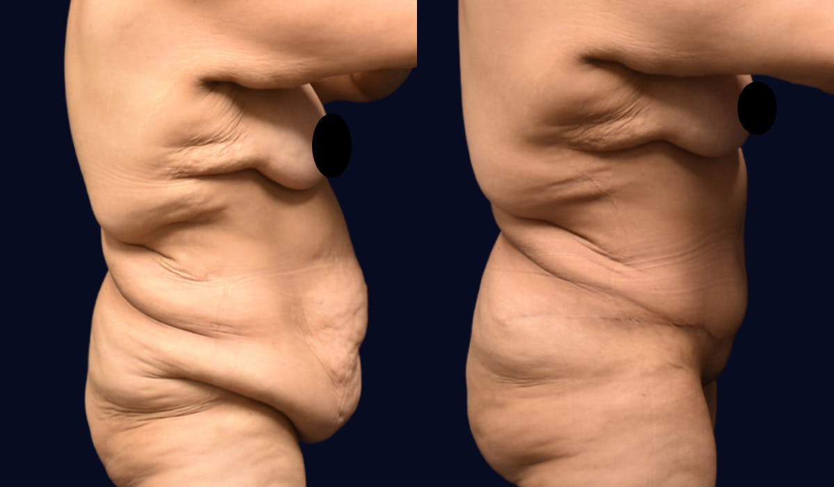 Fleur de Lis Before & After Gallery - Patient 610079 - Image 3