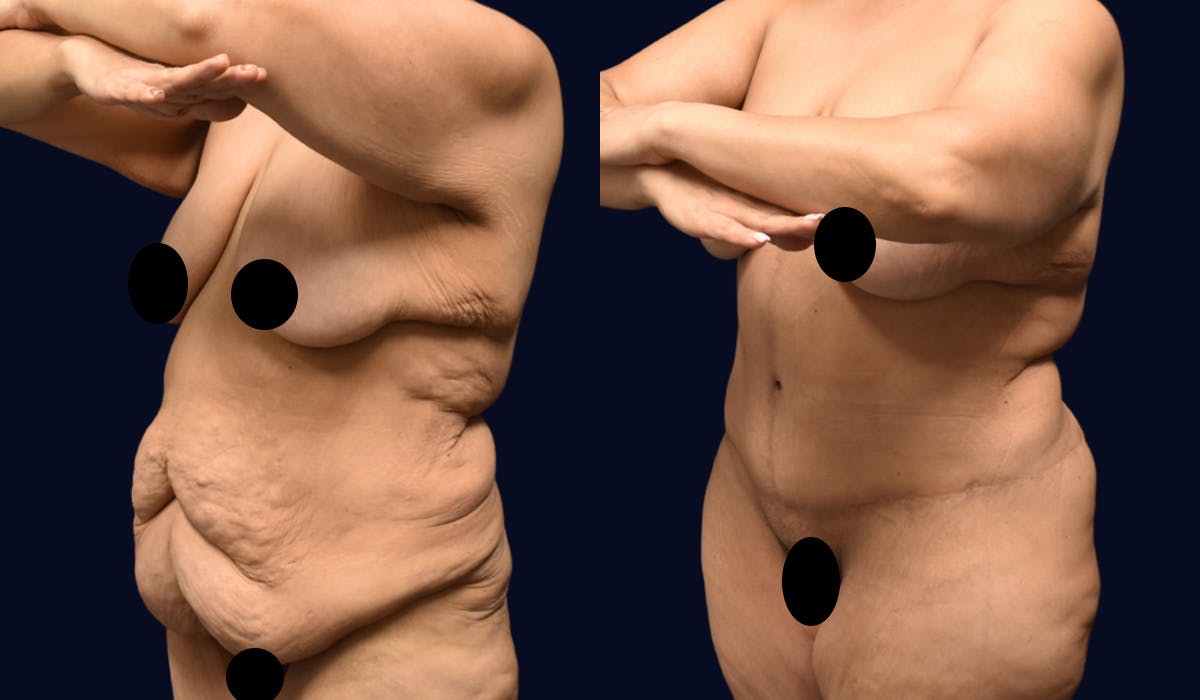 Fleur de Lis Before & After Gallery - Patient 610079 - Image 4