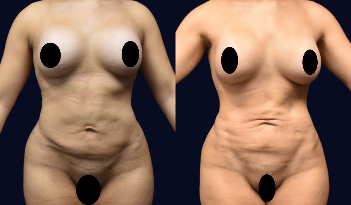Liposuction Before & After Gallery - Patient 462914 - Image 1