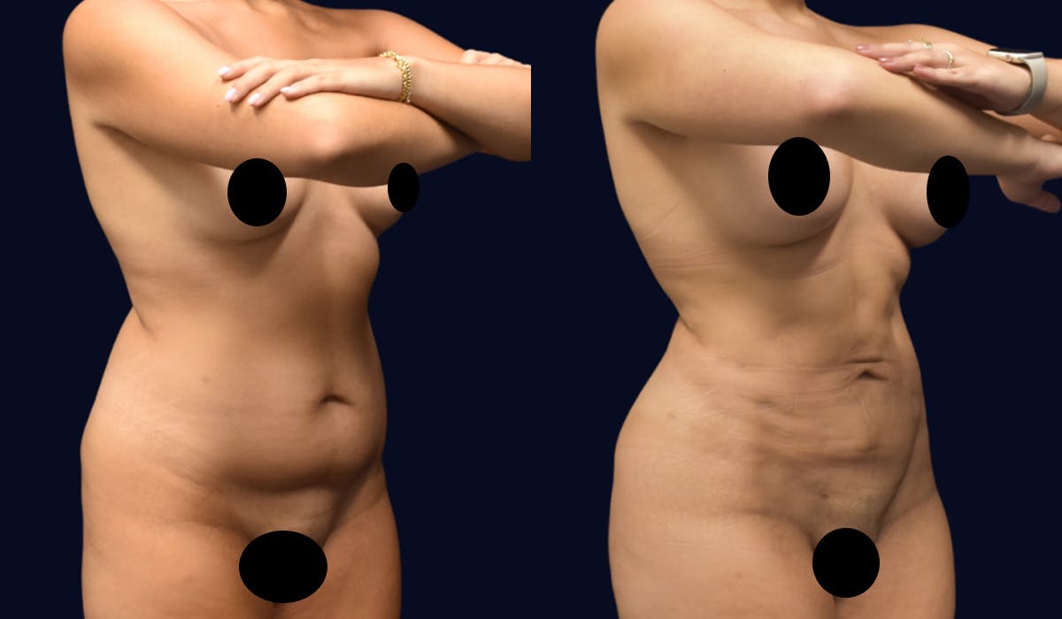 Liposuction Before & After Gallery - Patient 462914 - Image 2
