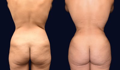 Brazilian Butt Lift Before & After Gallery - Patient 217606 - Image 1