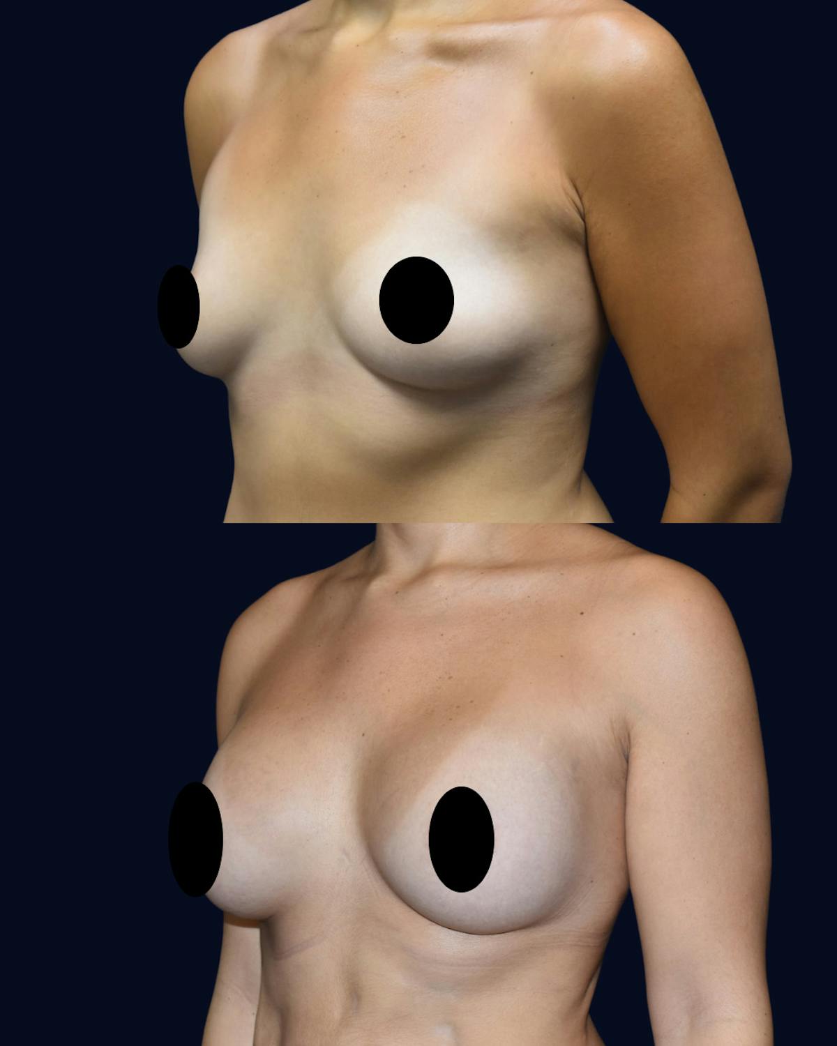 Breast Augmentation Before & After Gallery - Patient 342950 - Image 2